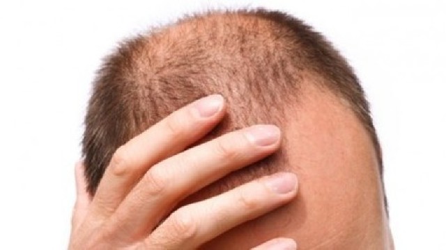 Cum percep bărbații căderea părului