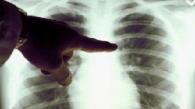 321 de oameni bolnavi de tuberculoză au murit anul trecut în Republica Moldova 