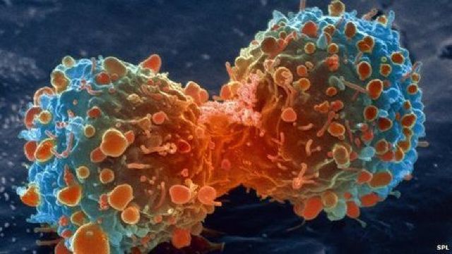 Cancerul unei persoane tratat cu ajutorul celulelor imunitare donate