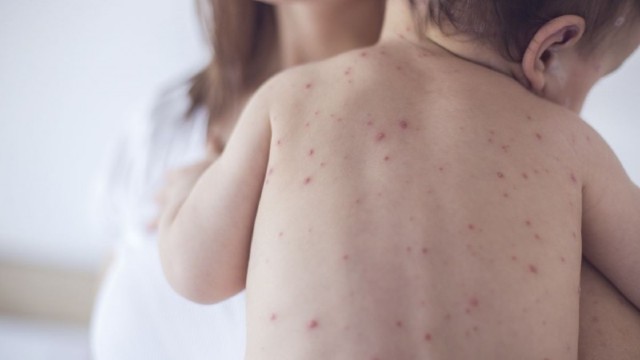 Ceadîr-Lunga | 16 copii s-au îmbolnăvit de rujeolă. Doar unul era vaccinat