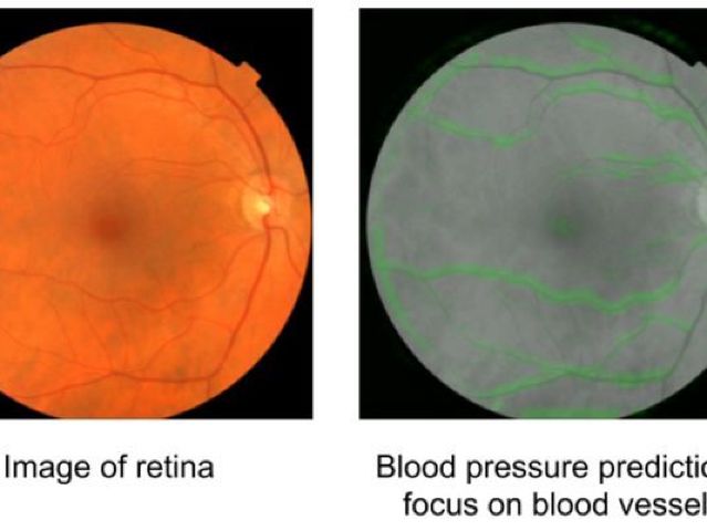 Google speră că Inteligența Artificială va putea prezice bolile cardiace doar prin observarea retinei