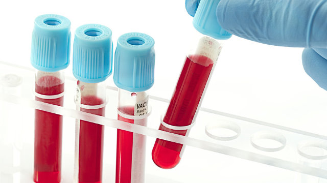 Cercetătorii din Australia anunță că au elaborat o tehnică de analiză de sânge care depistează melanomul