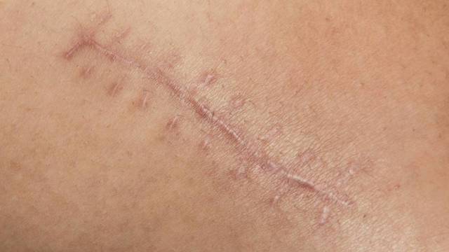 Chinezi au descoperit o metodă care ar putea ajuta la vindecarea rănilor fără a lăsa cicatrice