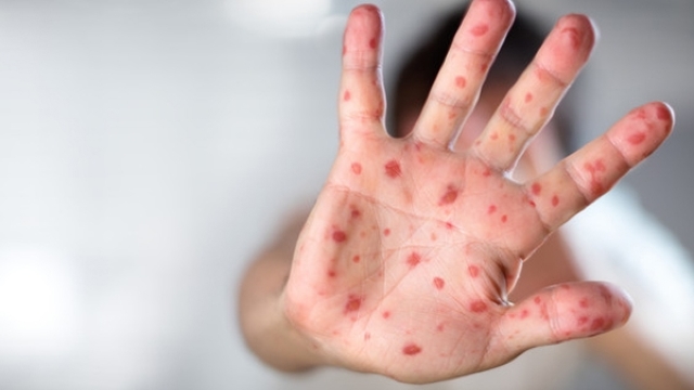 Ministerul Sănătății | O persoană din 1000 infestate cu virusul rujeolic moare