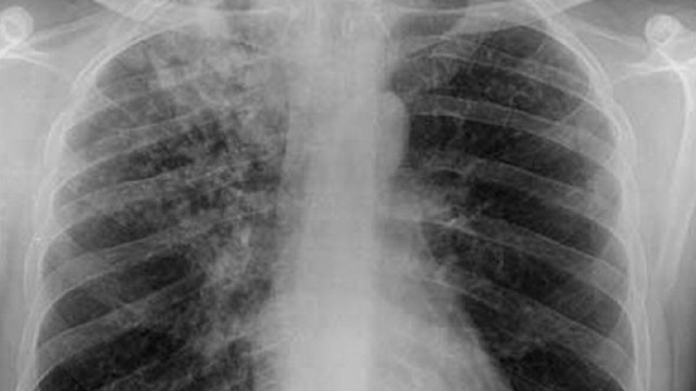 Republica Moldova este printre cele 30 de țări cu povară înaltă a tuberculozei 
