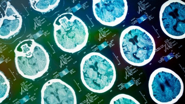 STUDIU | O nouă formă de demență asemănătoare bolii Alzheimer, identificată de oamenii de știință 