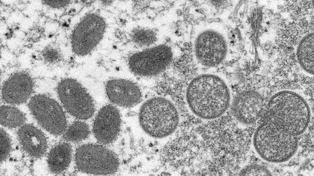 OMS: Nu există dovezi privind mutații ale virusului variolei maimuței. „Este o situație care poate fi ținută sub control”
