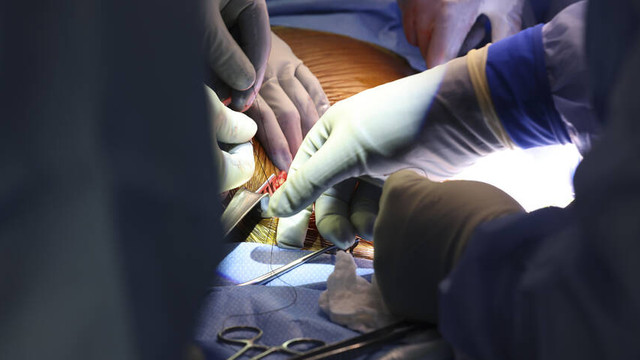 Chirurgi americani au transplantat un rinichi de porc la un pacient în viață, o potențială soluție la deficitul cronic de donări de organe