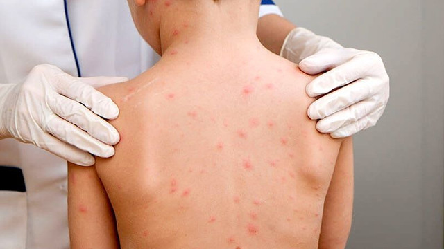 Alertă în municipiul Chișinău: Cinci cazuri confirmate de rujeolă și un caz suspect de meningită Alertă în municipiul Chișinău: Cinci cazuri confirmate de rujeolă și un caz suspect de meningită