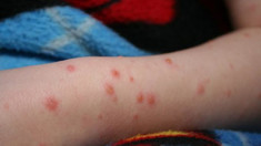 Încă un caz de rujeolă raportat în Chișinău. Autoritățile îndeamnă cetățenii să-și vaccineze copiii