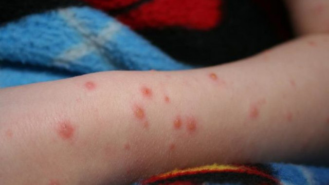 Încă un caz de rujeolă raportat în Chișinău. Autoritățile îndeamnă cetățenii să-și vaccineze copiii