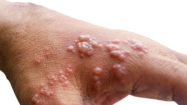 În Republica Moldova a fost depistat un caz de infecție cu variola maimuței